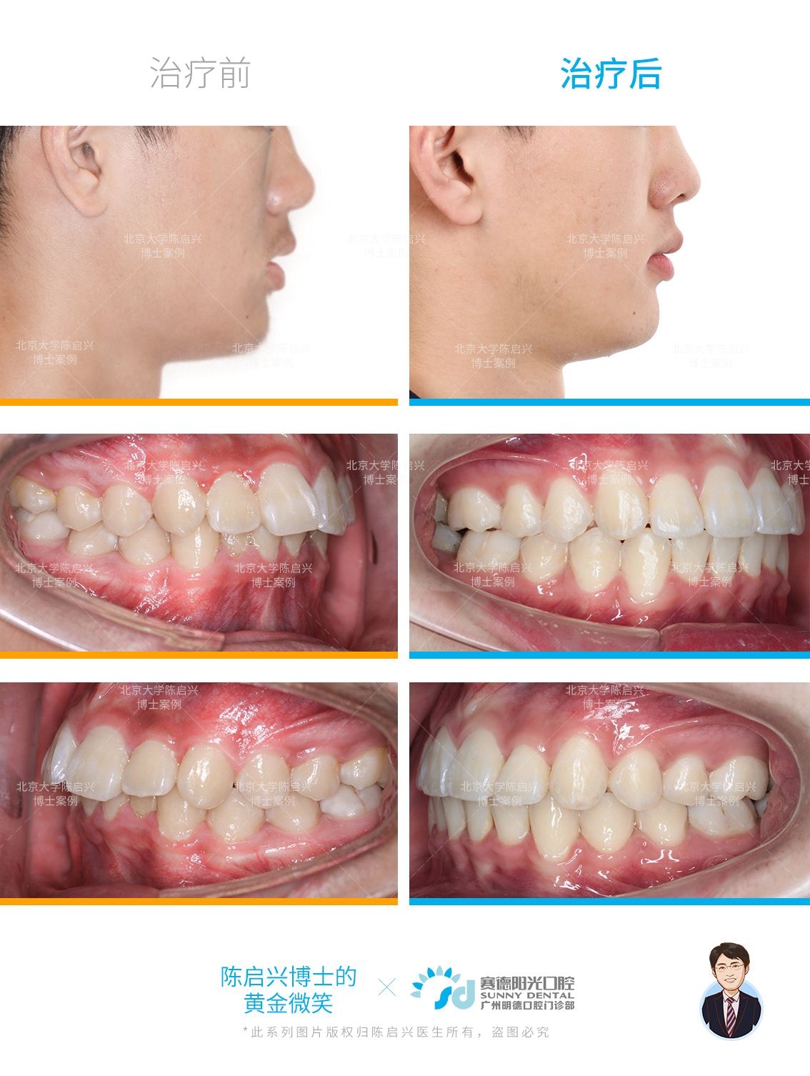 #上海牙齿矫正|面突+前牙区开颌案例⭐舌侧矫正优势！ - 知乎