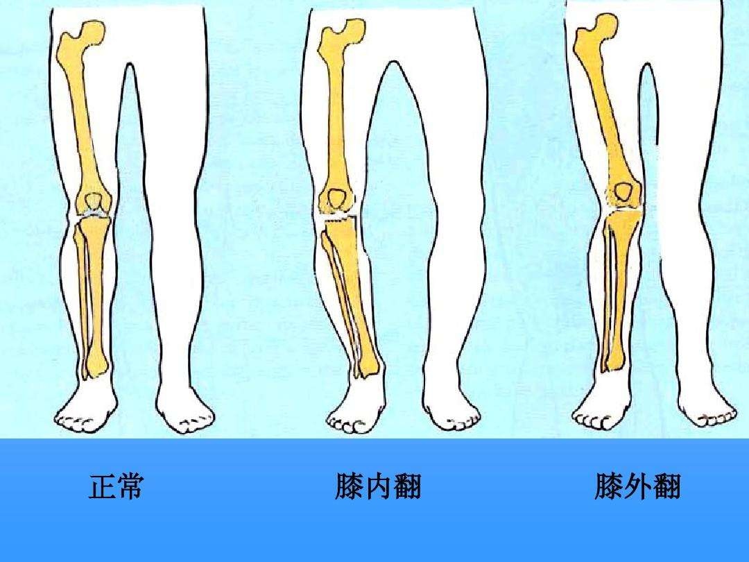 第四节 膝内、外翻截骨矫形术-外科学-医学