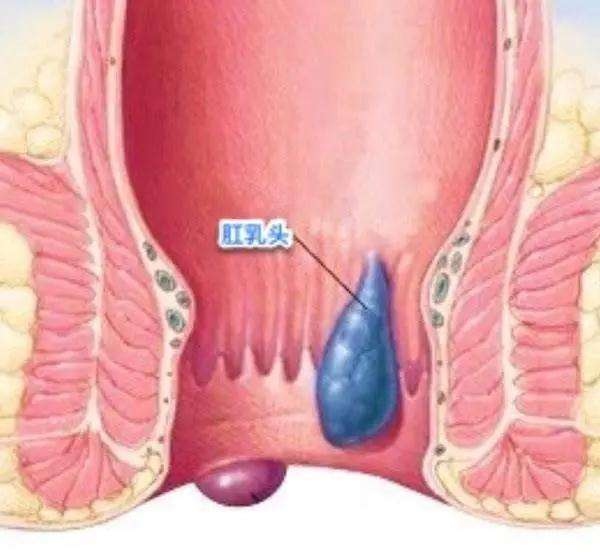混合痔疮脱肛图片