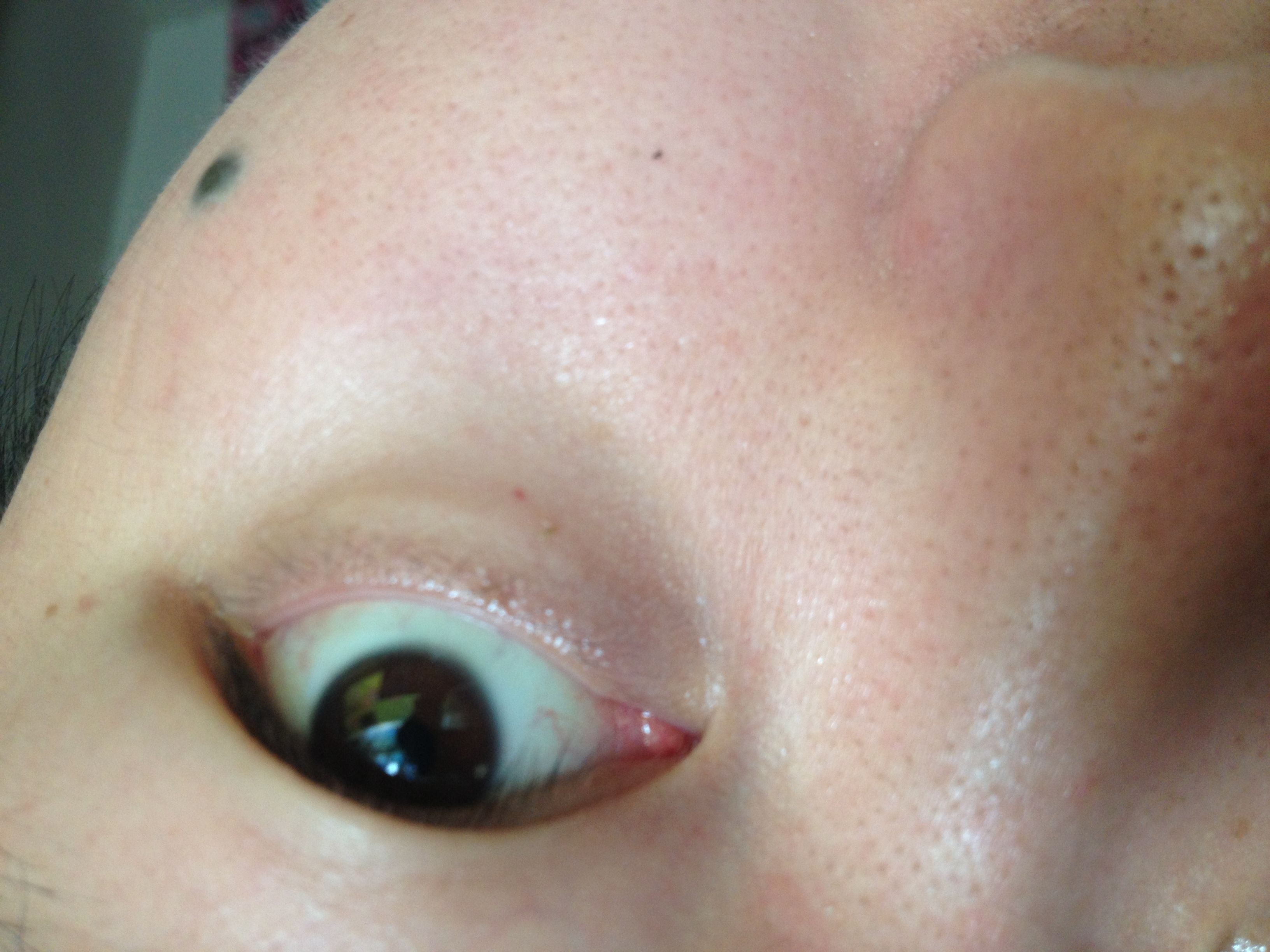 眼很红眼黑眼白的交界处有突起还有很多血丝是怎么了 是结膜炎吗。不要被吓住哦，这是为了让你们看清楚。_百度知道