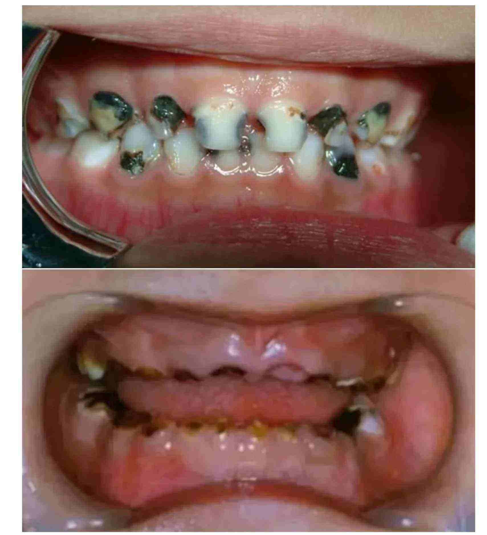 大牙缺失有什么影响？危害大吗-爱康健齿科
