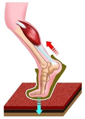 跟腱炎怎样治疗好得快