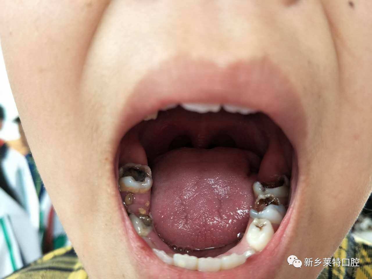 六龄齿蛀牙严重图片