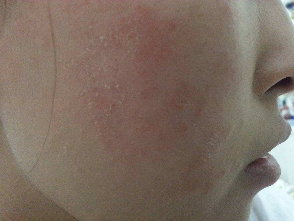 脸上脱皮干燥出癣图片