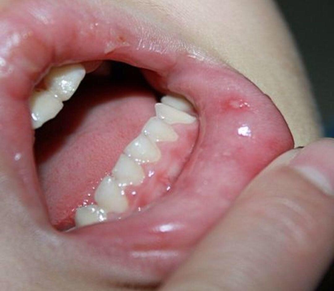 下唇肿胀的儿童会感染脓肿，导致口腔溃疡 库存照片. 图片 包括有 关心, 慢性, 溃疡, 人员, 特写镜头 - 210807918