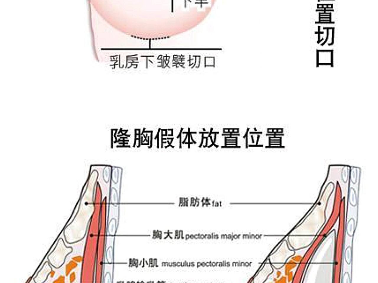 下皱襞切口疤痕图片