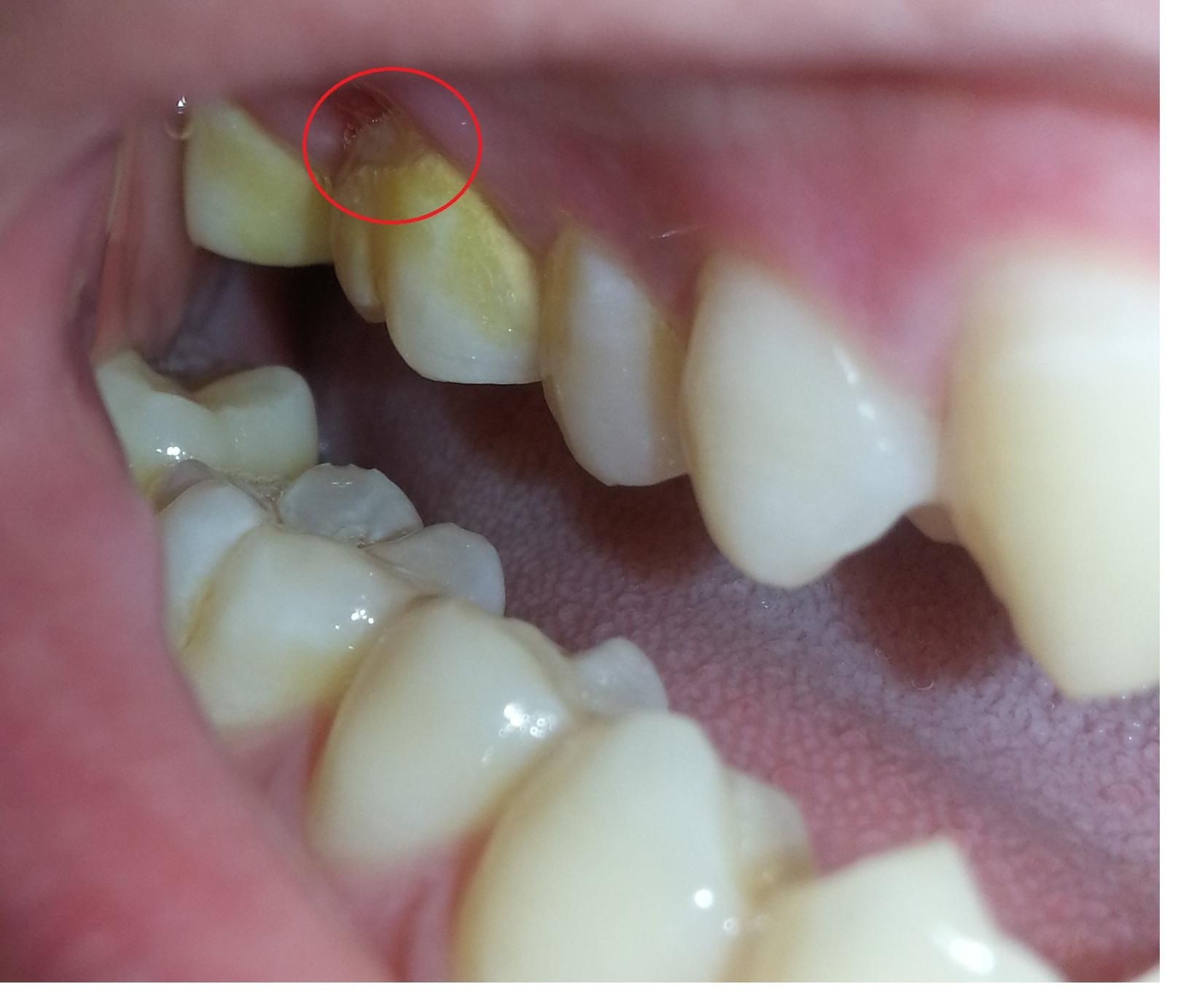 牙齒有酸酸的感覺，牙齒是怎麼了呢？ part IV:牙根裂掉 - 牙科美容資訊 - 美容牙科張凱榮醫師