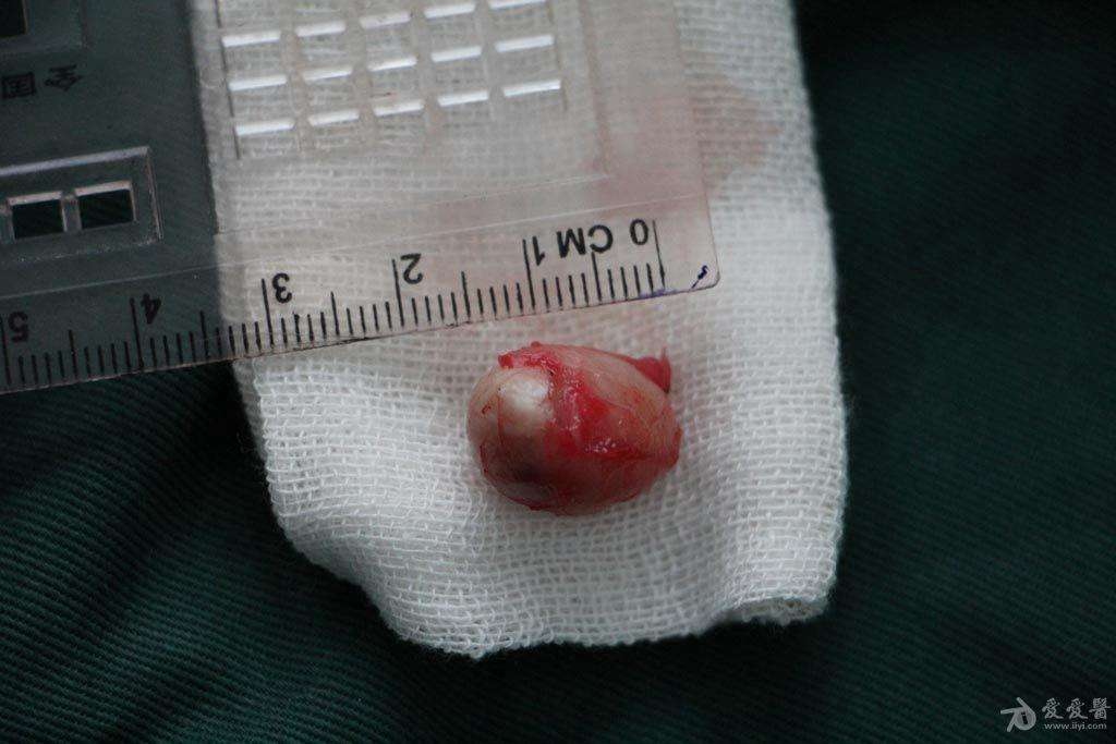 脂腺囊肿