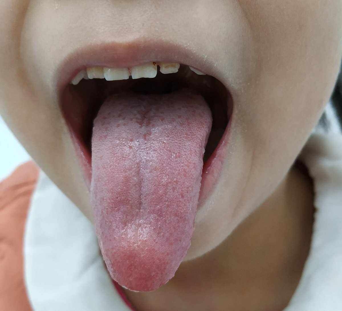 舌头凹凸不平，舌苔厚是怎么回事？_百度知道