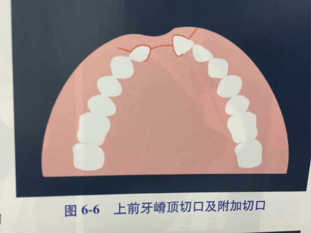 两阶段整复理念与技术在成年牙槽突裂鼻翼基底重建的应用初探