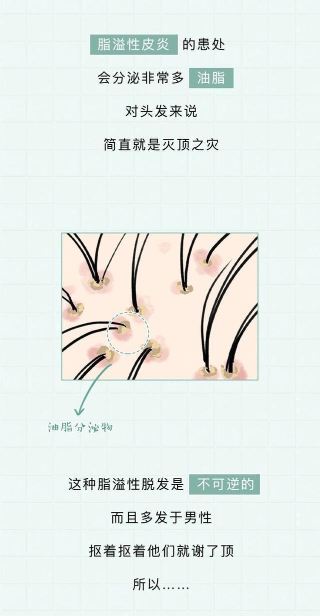 头皮脂肪粒图片