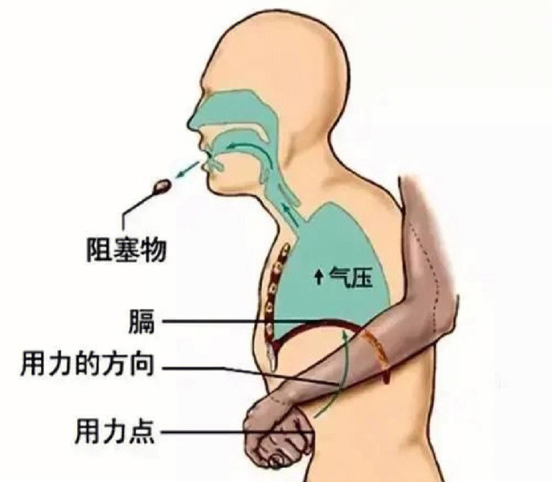 哈姆立克急救法