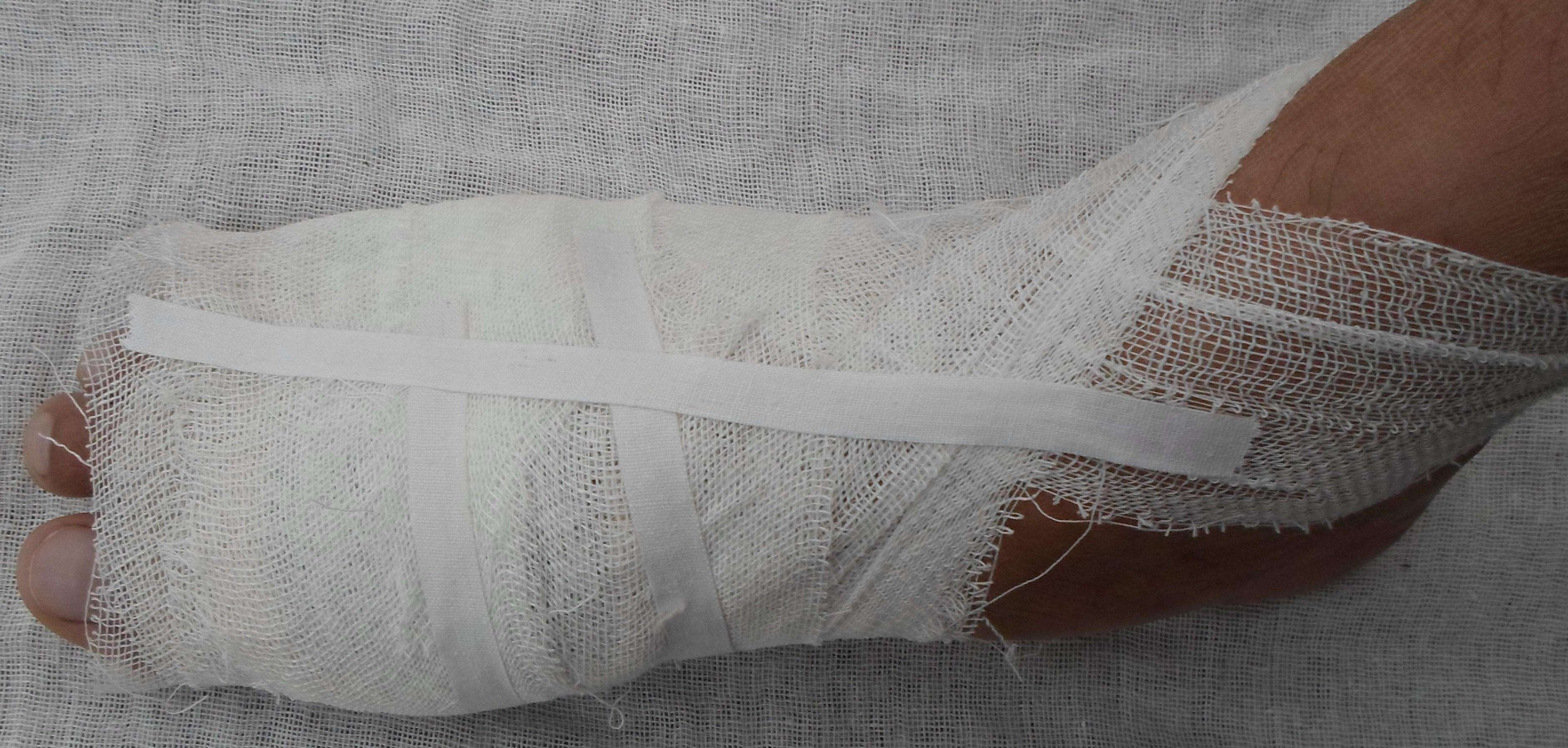 骨折后，医生在患者前臂和手腕上使用石膏石膏和绷带固定。照片摄影图片_ID:309685568-Veer图库