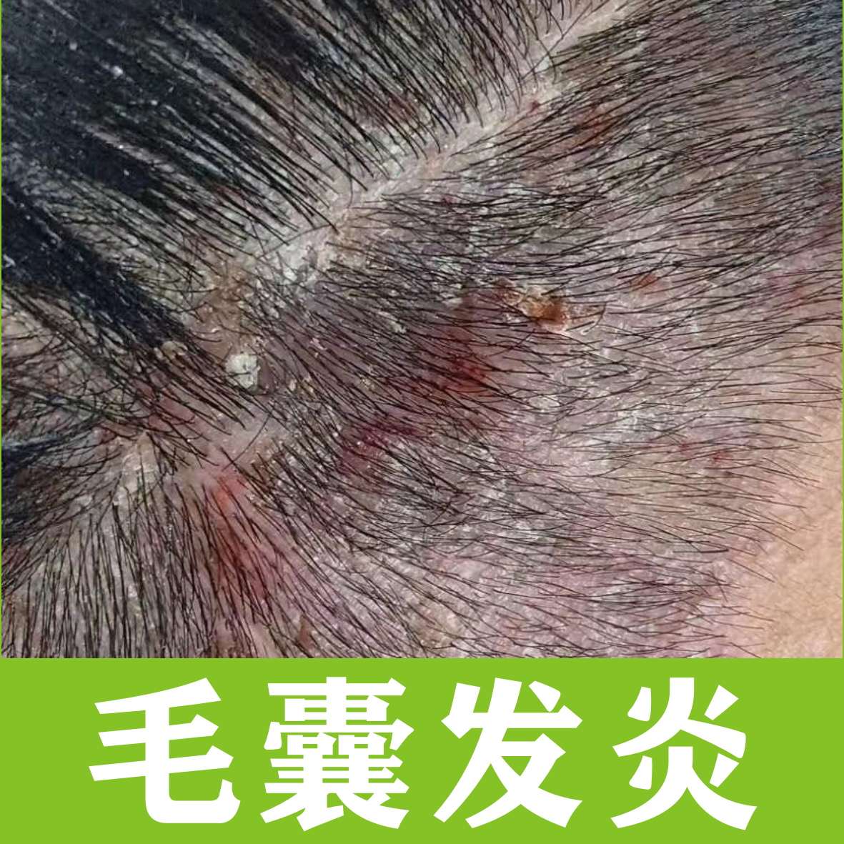 马拉色菌毛囊炎的治愈全过程（亲身经历）图片可能引起不适请谨慎观看 - 知乎