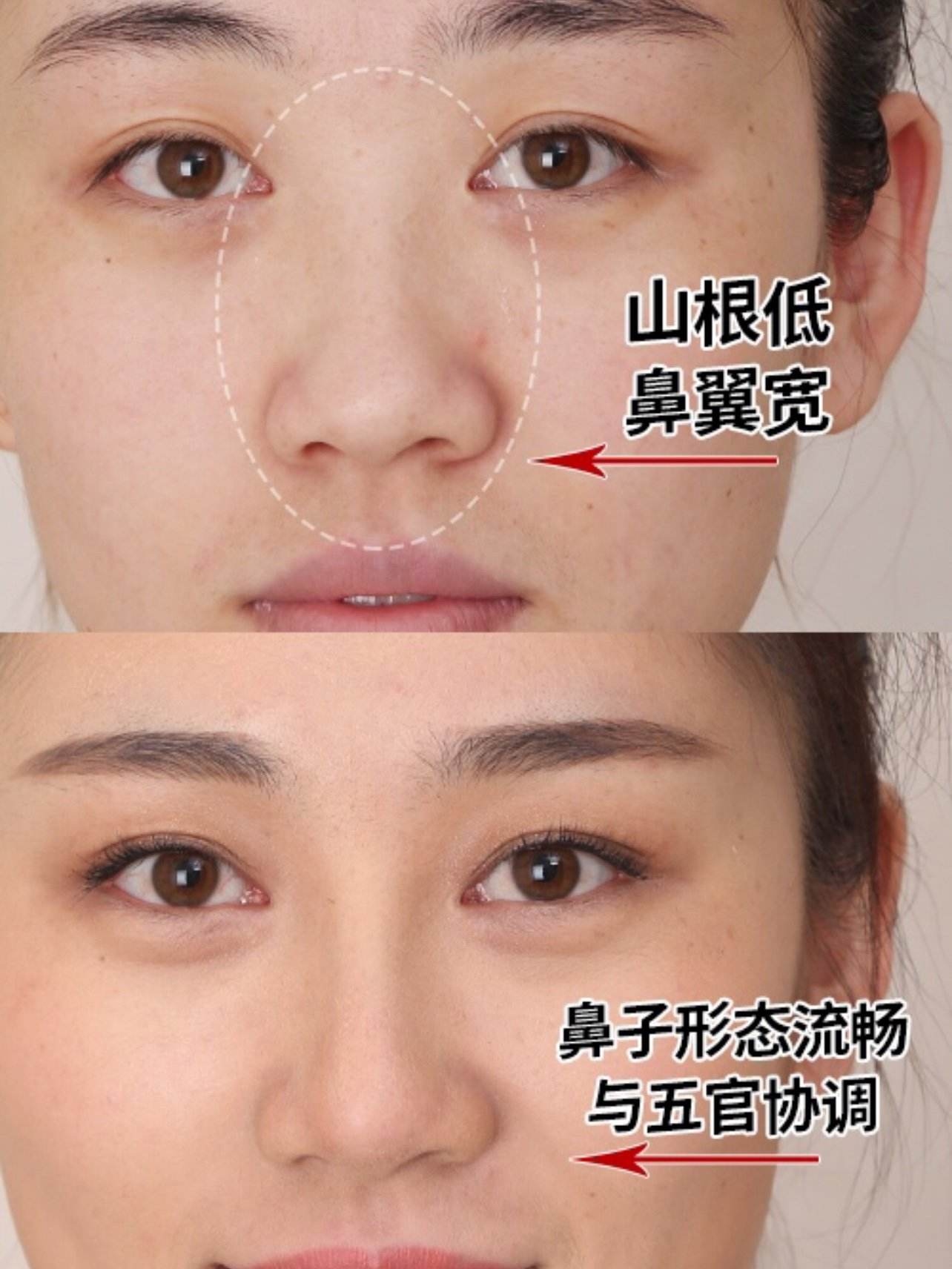 隆鼻重修二次隆鼻-精緻秀氣鼻型案例分享-韋志曄醫師