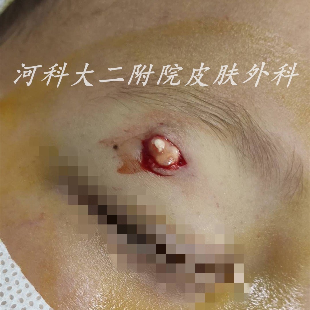 皮囊肿的症状和图片