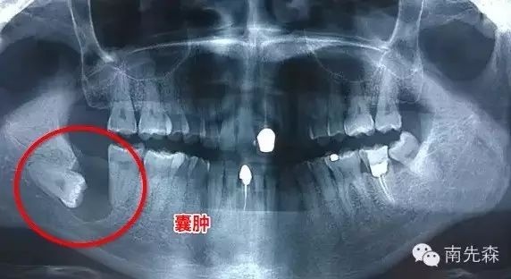 南先森遇到的真实病例智齿可以引起颌骨的萌出性囊肿,破坏颌骨,沿重 萌出囊肿示意图