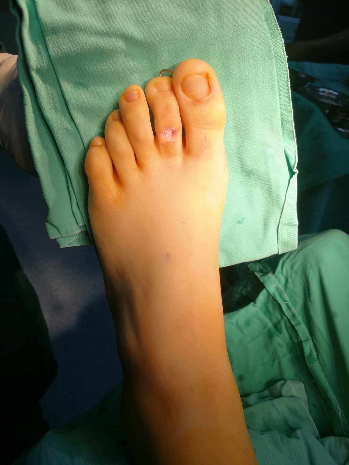 大脚趾关节疼痛的 5 个常见原因 - 知乎