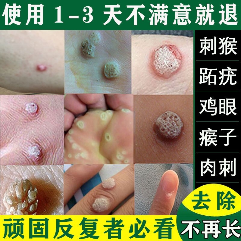 去疣灵图片