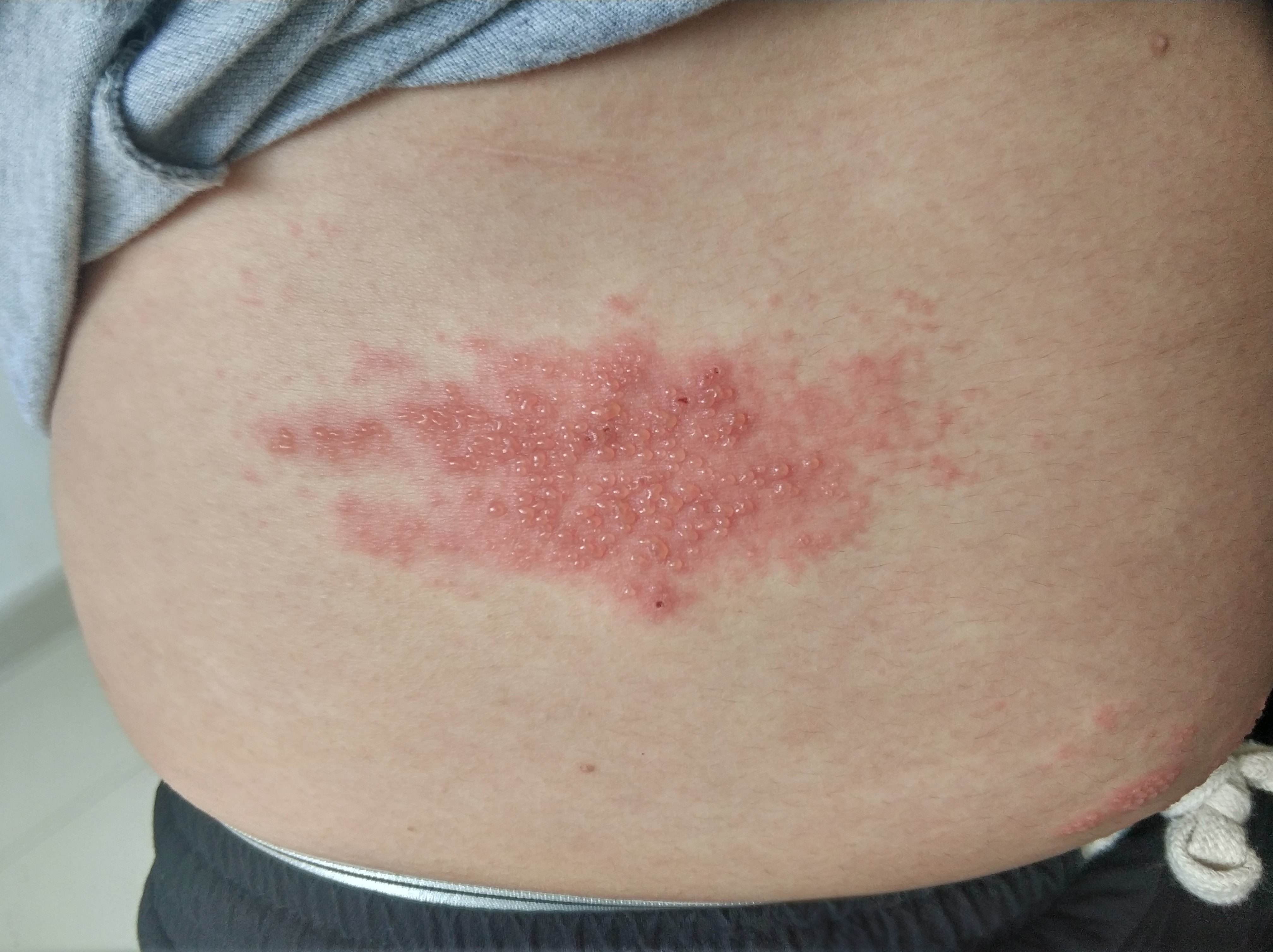 蔡凱淇醫師 皮膚專科: 打完COVID-19疫苗之後長了帶狀疱疹？