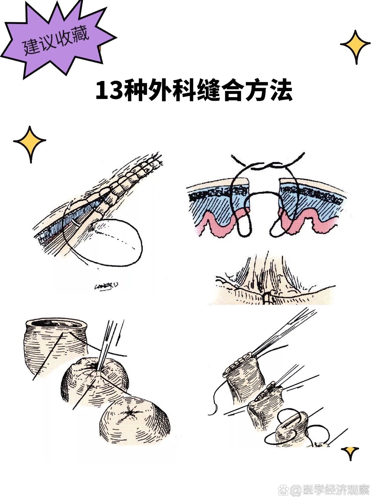 13种外科缝合方法 去骨瓣减压术手术图解