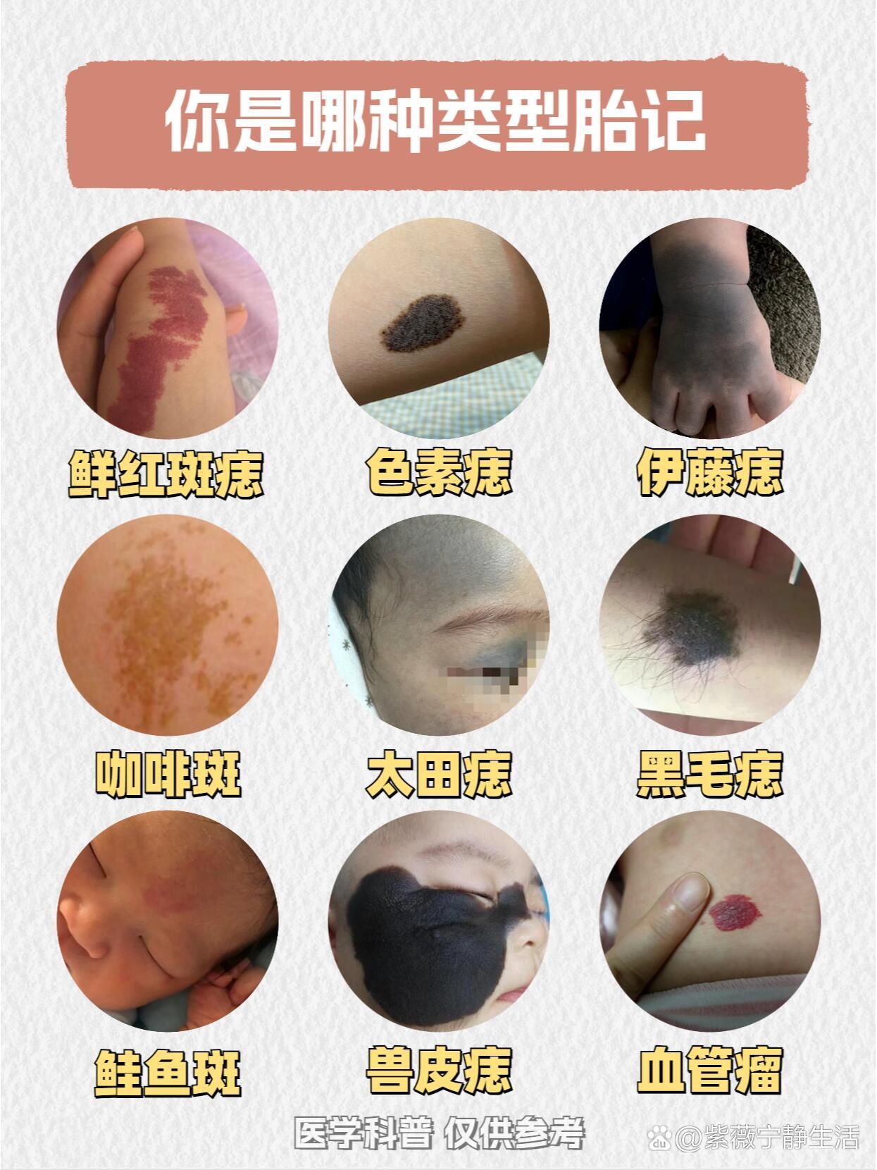 胎记是什么原因引起的