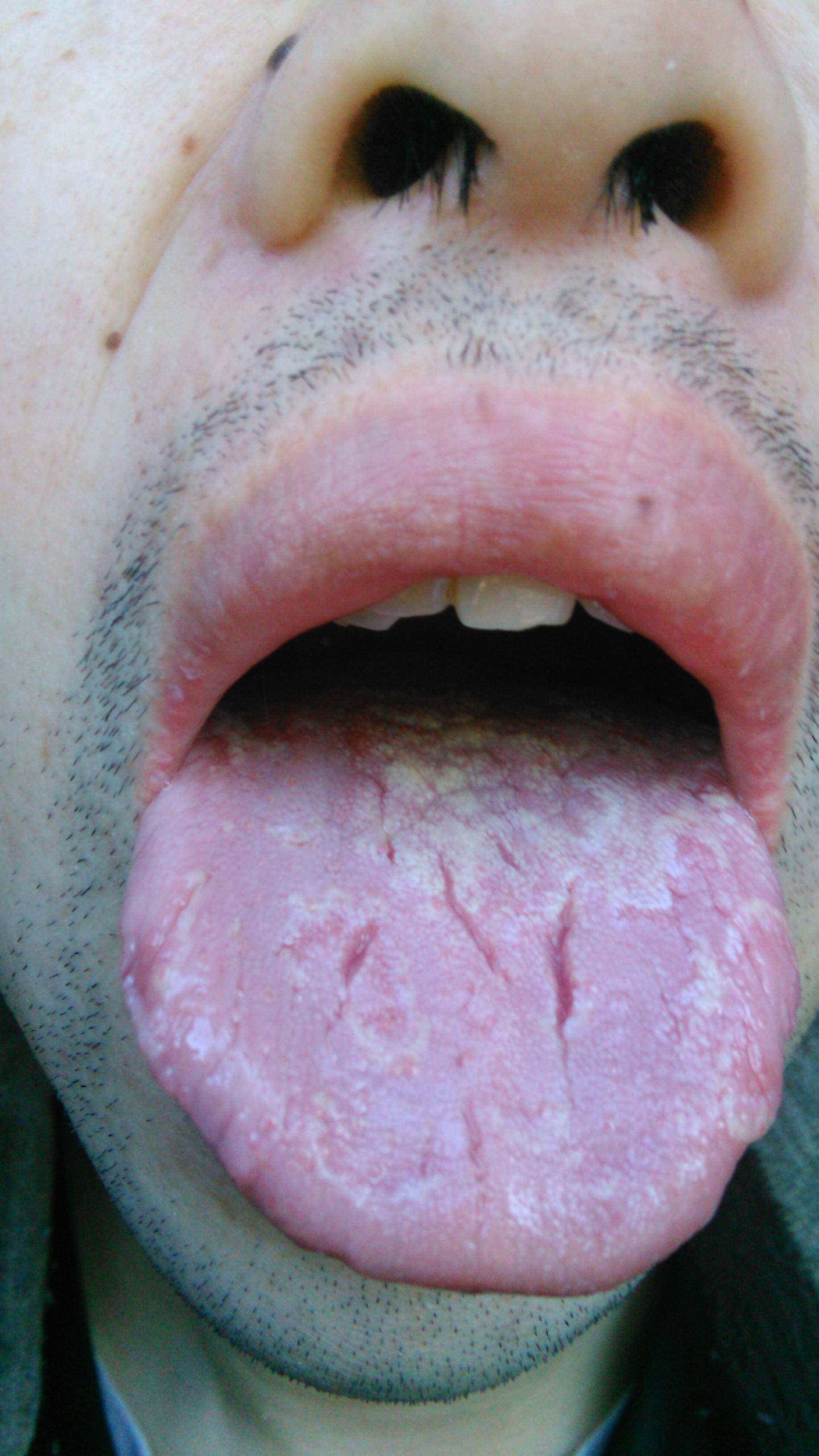 整个舌头都发白 后舌厚 上面都有小红点 还有齿痕_百度知道