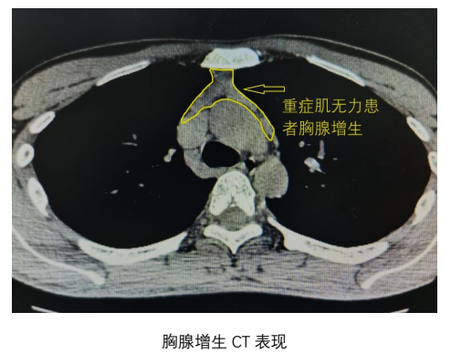 胸腺增生ct图片