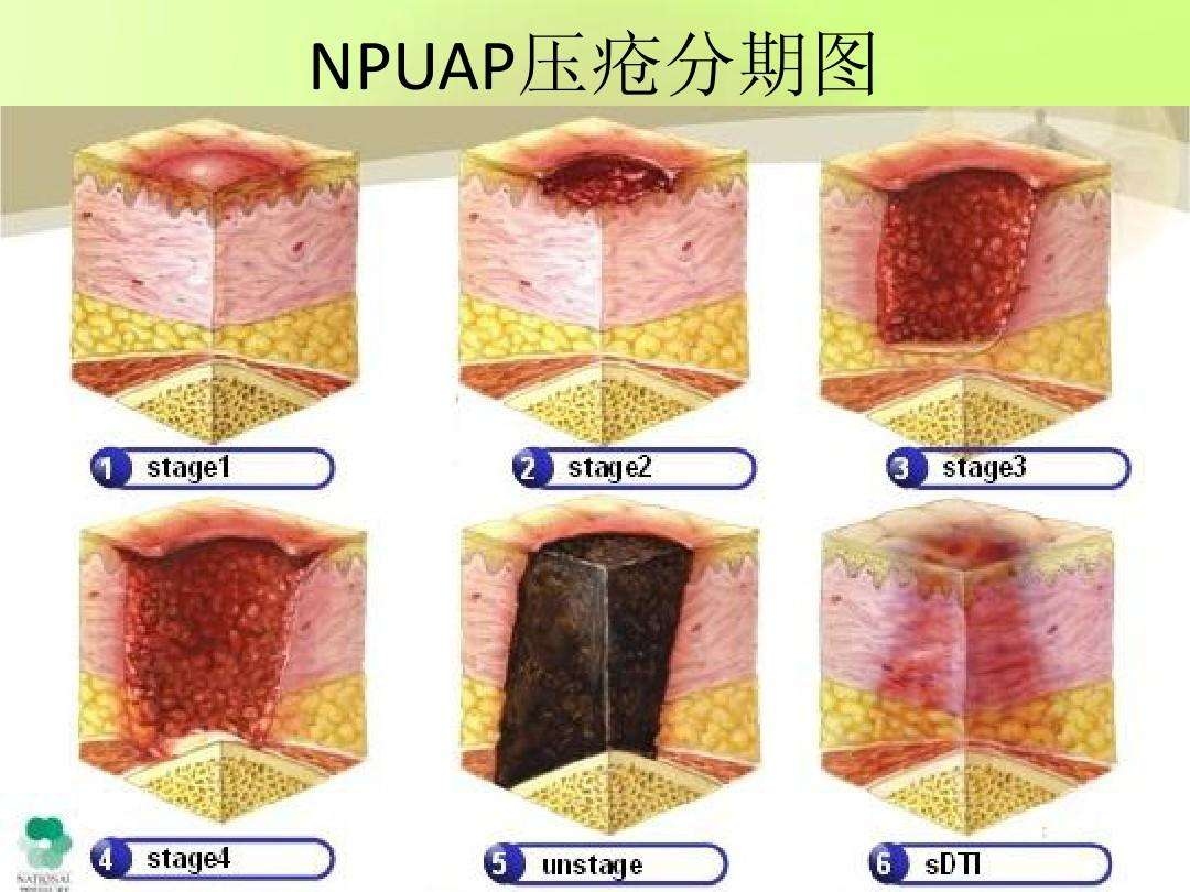 压疮的六个分期图片