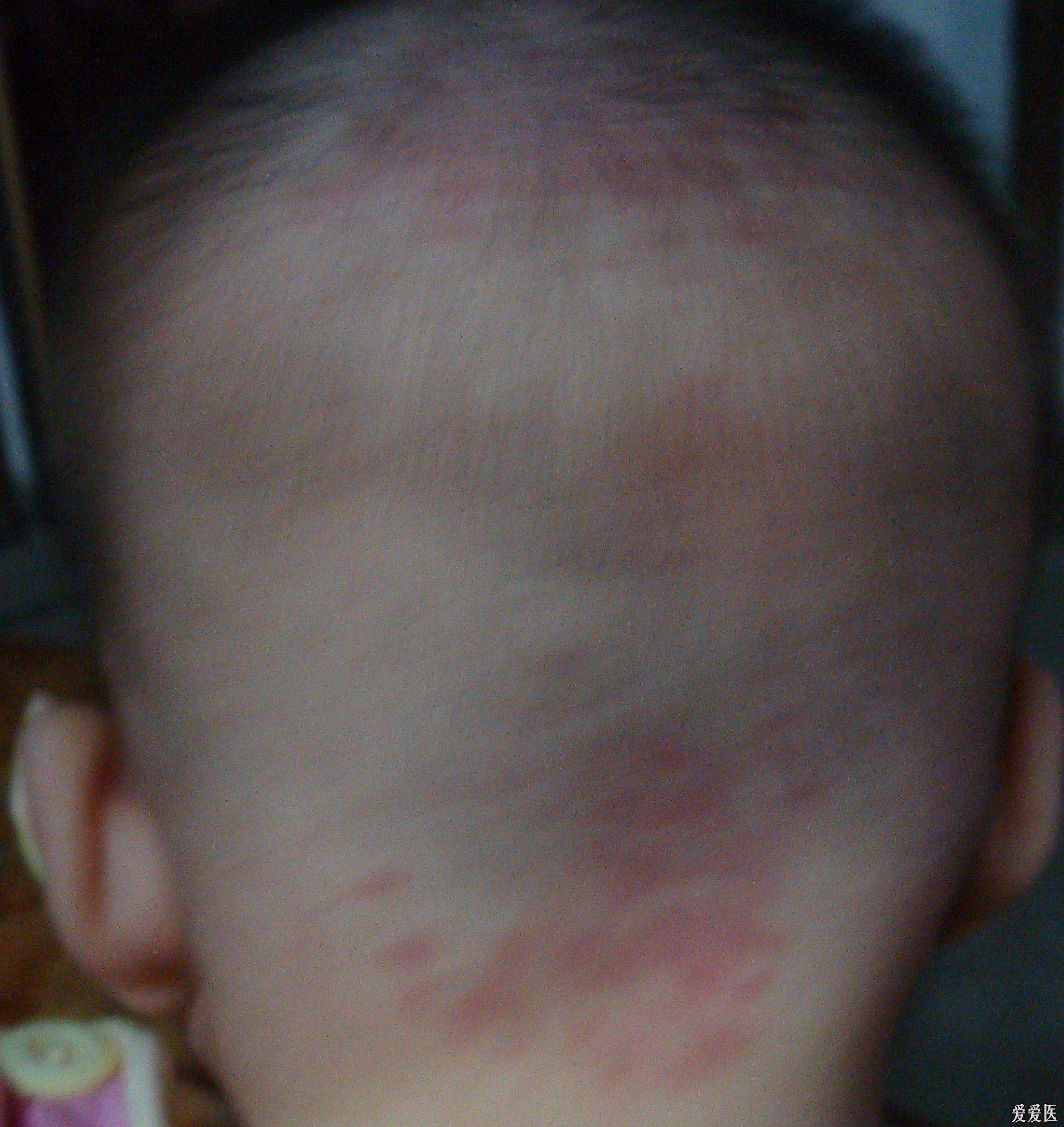 婴儿脸上有紫色点点（宝宝身上有鲜红斑痣）-幼儿百科-魔术铺