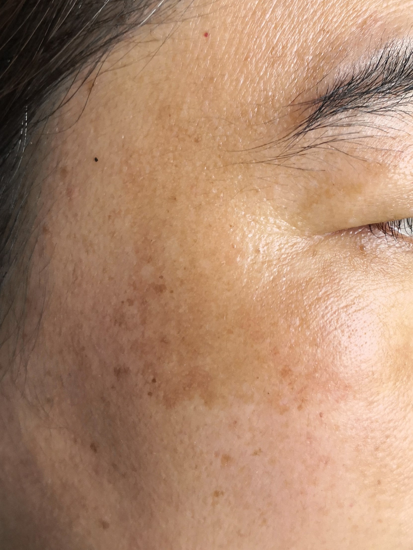 皮肤色素沉淀怎么办？新加坡专业治疗雀斑、黄褐斑、老人斑、日晒斑